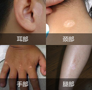 郑州市那个专科看白癜风比较好