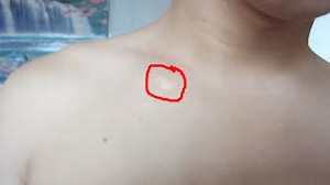 河南哪里治疗白癜风做的好